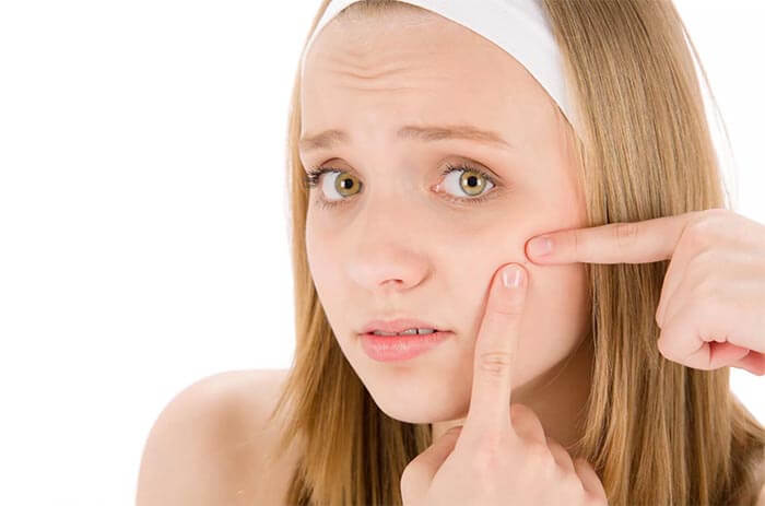 Acne vulgaris among adolescents