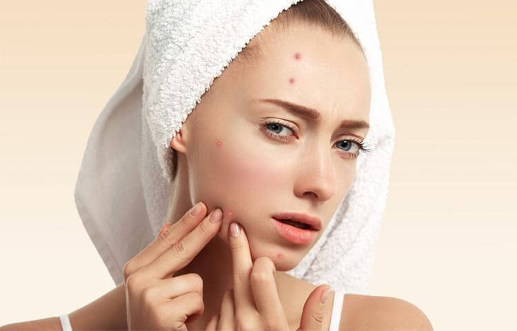 Causes of hormonal acne