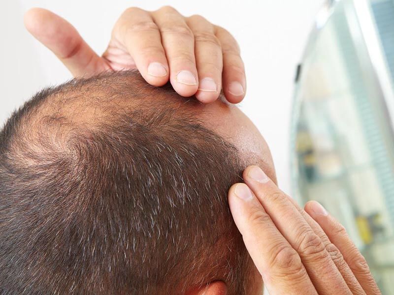 Hair loss and its treatment